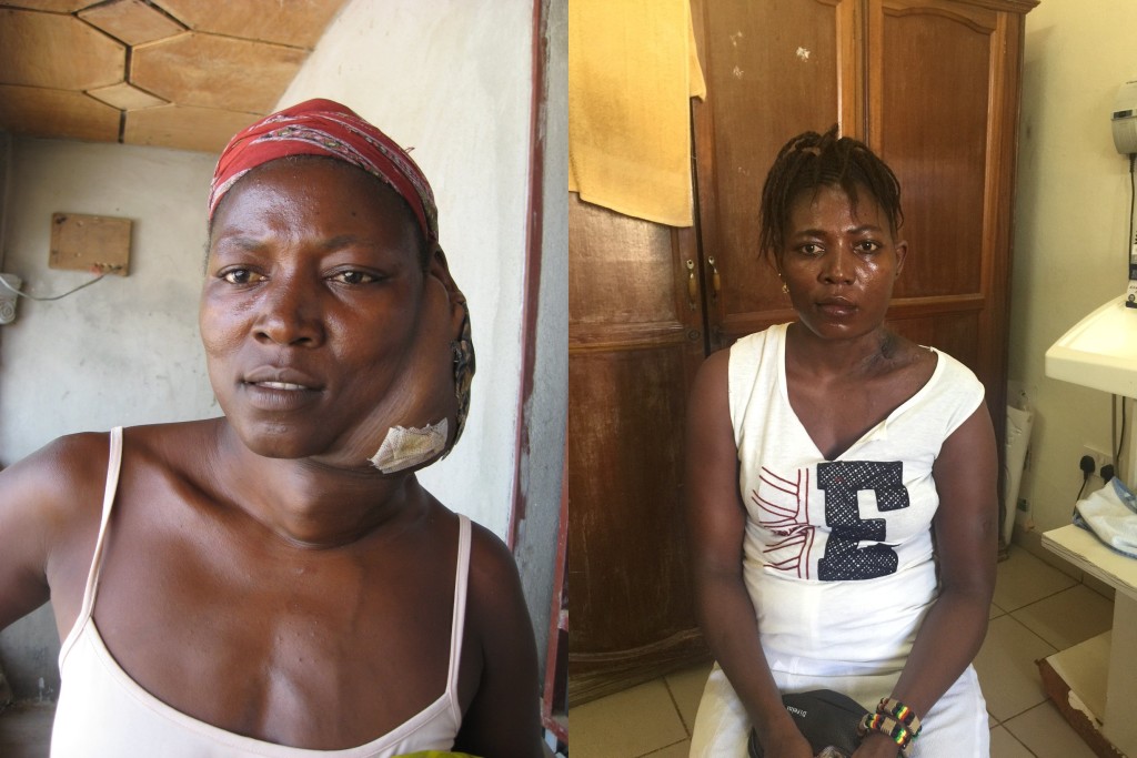Mamusu before her operation (left) and after the removal of her tumor (right)