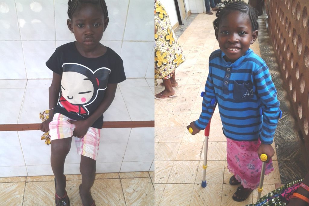 Mariatu met een pijnlijke infectie in haar rechterbeen voor (links) en na haar operatie (rechts)