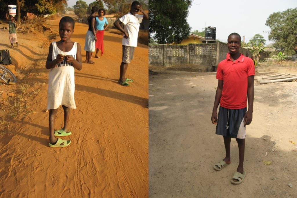 Abu Bakar with two clubfeet (left) en after two years of medical help (right)