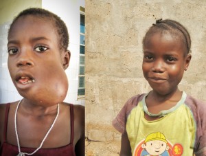 Hassanatu before (left) and after chemotherapy (right) 