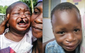 Isatu before her surgery (left) and after surgery (right)