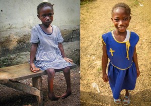 Mary before her surgery (left) on her feet and after her surgery (right)