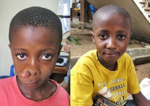Mohamed before surgery (left) and after his surgery (right)