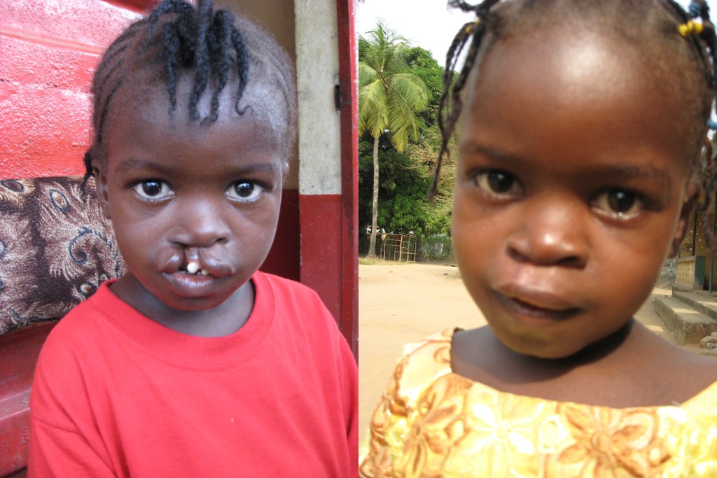 Zinab before her operation (left) and after her operation (right)